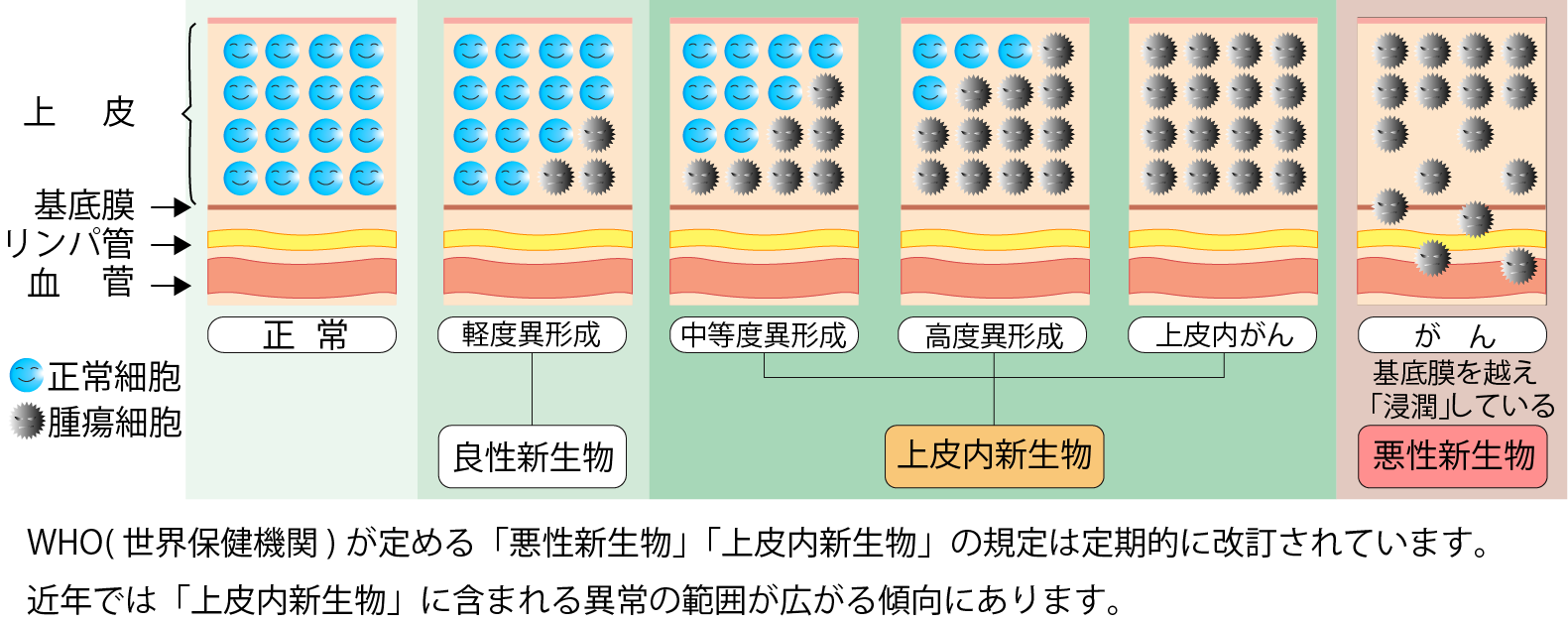 上皮内新生物と悪性新生物の違い
